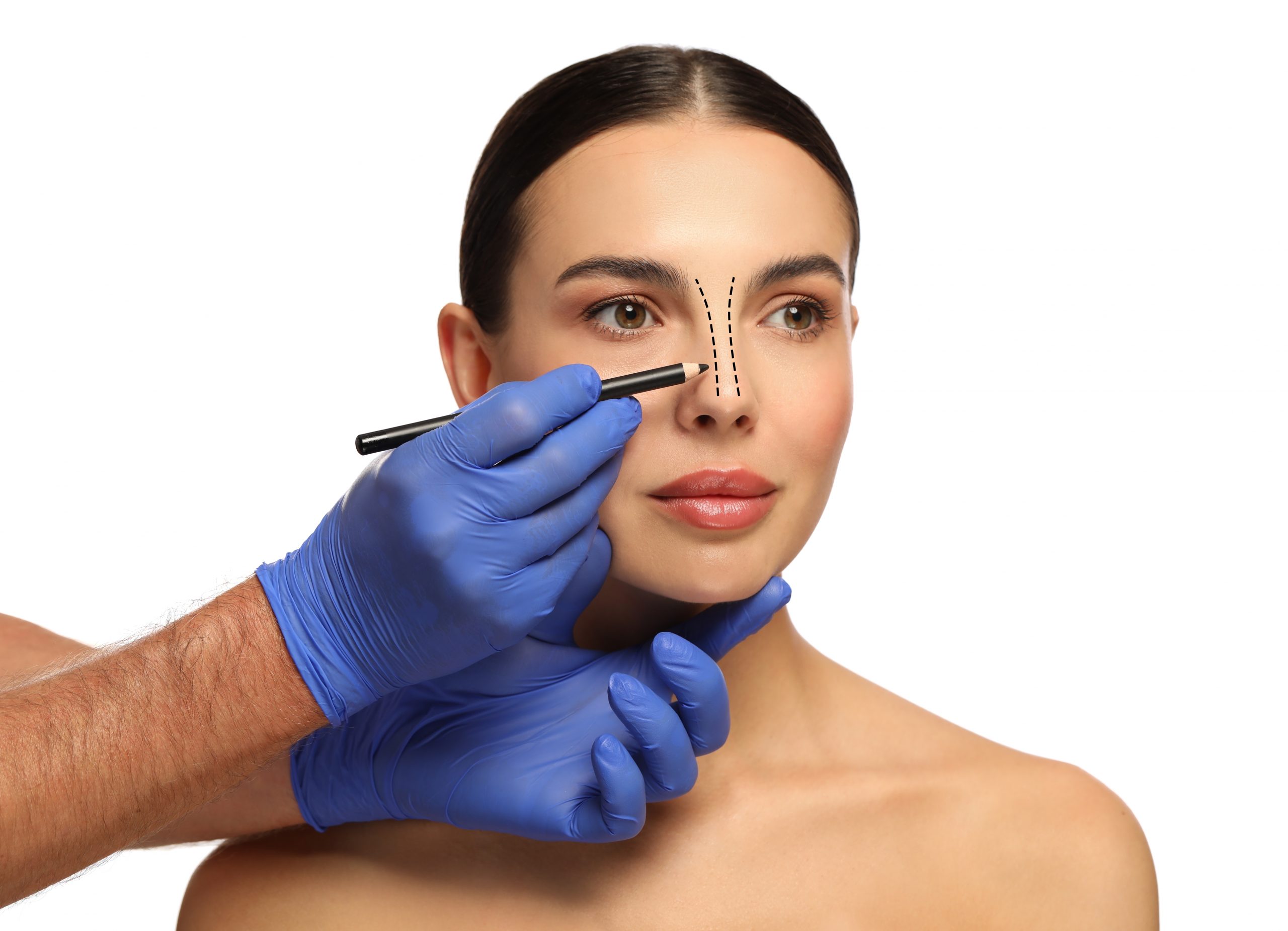 Rinoplastia en Mallorca con técnica Duvet — Dr. García Ceballos