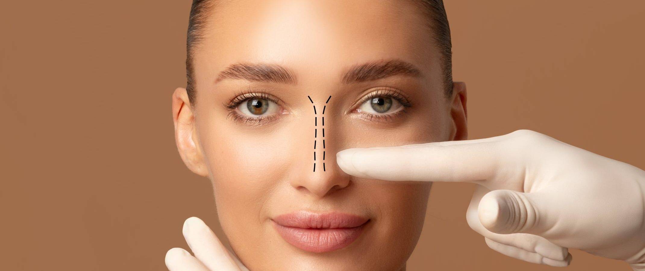 rinoplastia