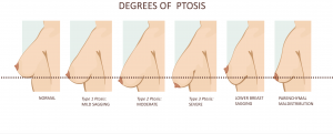 Grados de ptosis mamaria: leve, moderada, severa y pseudoptosis