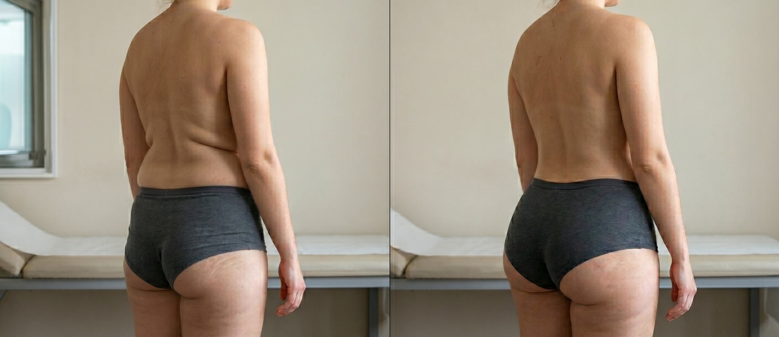Brazilian Butt Lift – lipotransferencia a glúteos