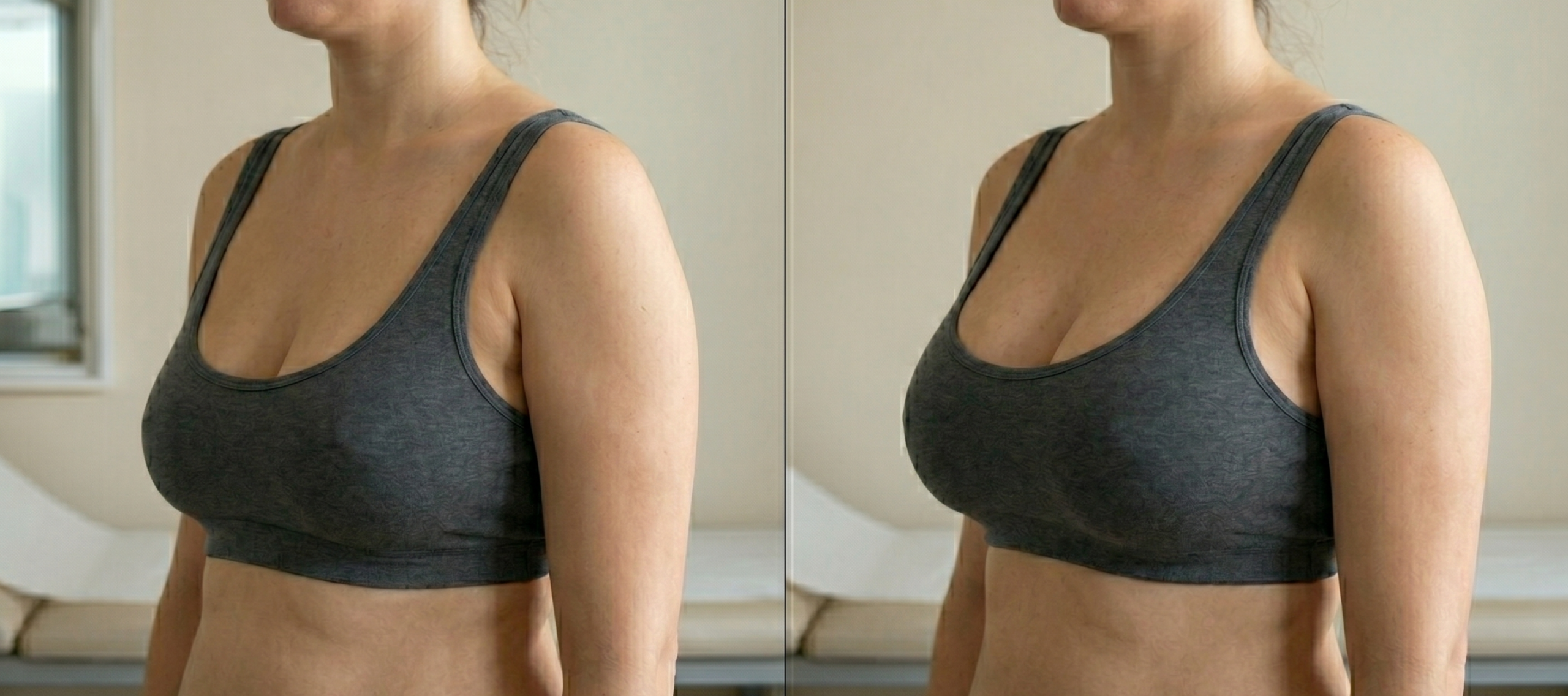 Lipofilling mamario – aumento de pecho con grasa propia