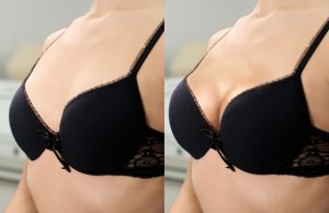 Mujer tras una mastopexia (elevación de pecho) con técnica BAGS en Mallorca, resultado natural y elevado