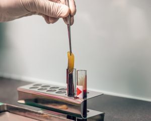 Procesado de L-PRF (plasma rico en fibrina leucocitaria) para lipofilling mamario en Mallorca